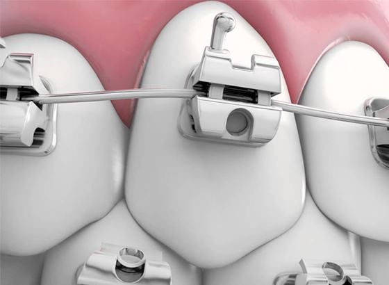 Khám phá chi tiết ưu nhược điểm các loại niềng răng phổ biến nhất.